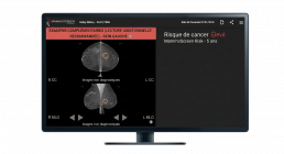 ecran mammoscreen risque