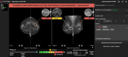 interface mammoscreen comte rendu