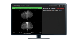 ecran prediction du risque du cancer mammoscreen